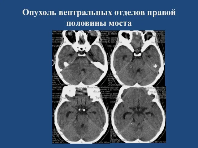 Опухоль вентральных отделов правой половины моста