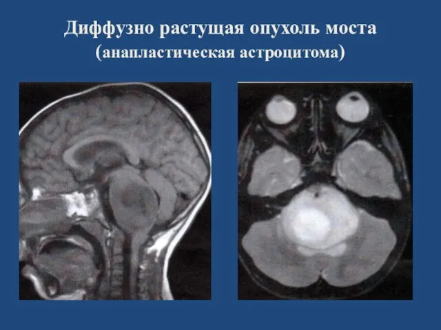 Диффузно растущая опухоль моста (анапластическая астроцитома)