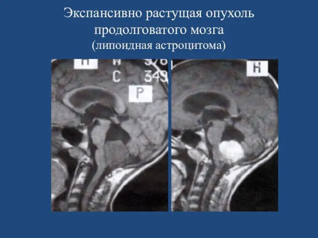 Экспансивно растущая опухоль продолговатого мозга (липоидная астроцитома)