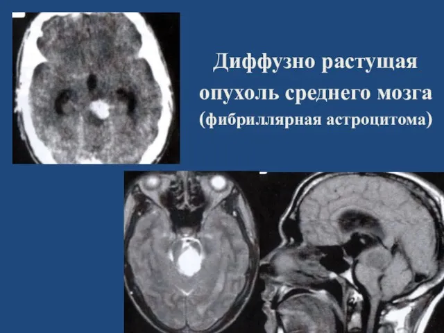 Диффузно растущая опухоль среднего мозга (фибриллярная астроцитома)