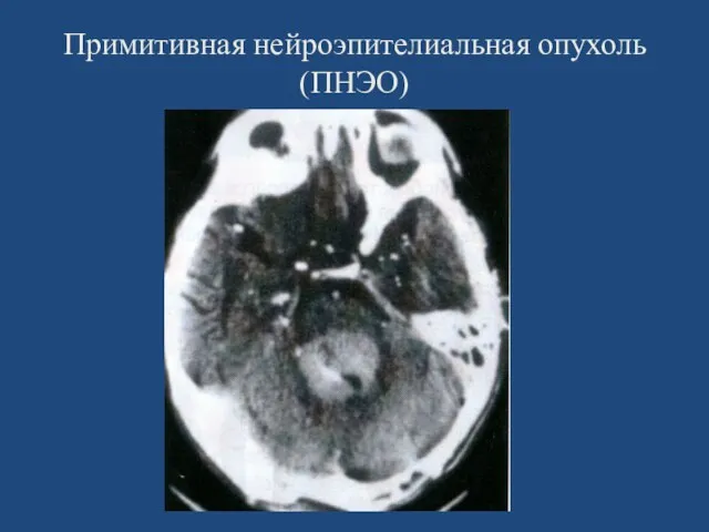 Примитивная нейроэпителиальная опухоль (ПНЭО)