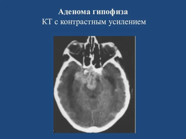 Аденома гипофиза КТ с контрастным усилением