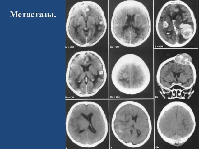 Метастазы.