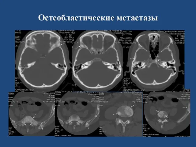 Остеобластические метастазы