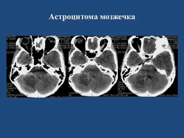 Астроцитома мозжечка