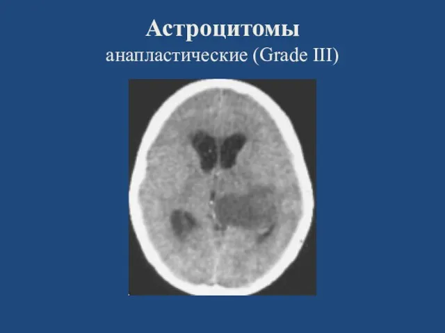 Астроцитомы анапластические (Grade III)