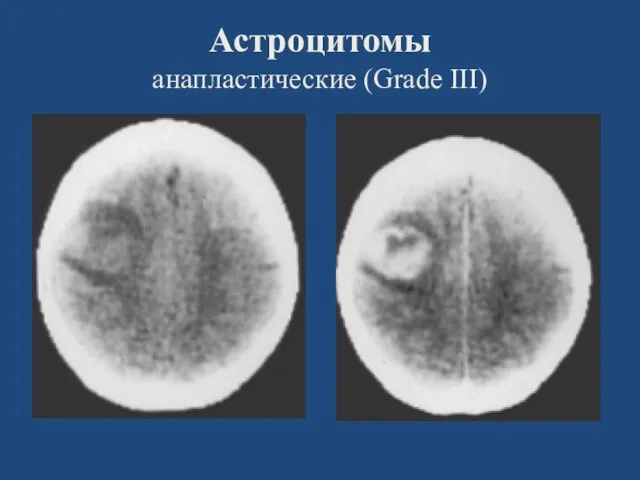 Астроцитомы анапластические (Grade III)