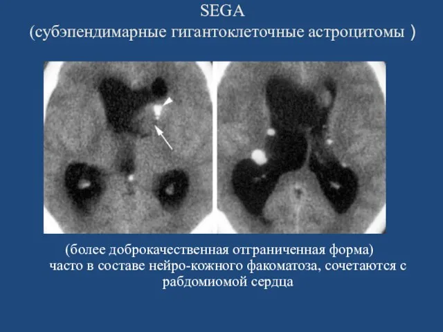 SEGA (субэпендимарные гигантоклеточные астроцитомы ) (более доброкачественная отграниченная форма) часто