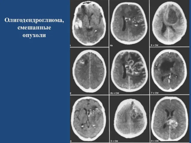 Олигодендроглиома, смешанные опухоли