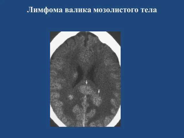 Лимфома валика мозолистого тела
