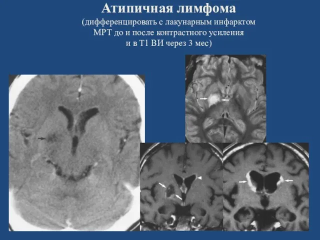 Атипичная лимфома (дифференцировать с лакунарным инфарктом МРТ до и после