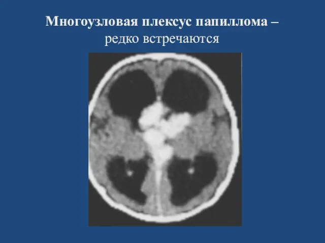 Многоузловая плексус папиллома – редко встречаются