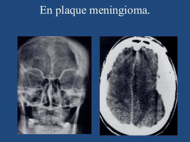 En plaque meningioma.