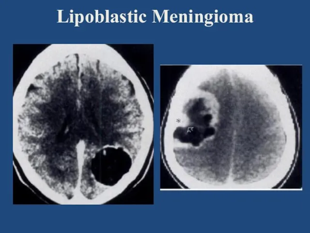 Lipoblastic Meningioma
