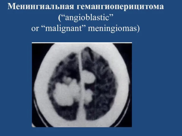 Менингиальная гемангиоперицитома (“angioblastic” or “malignant” meningiomas)