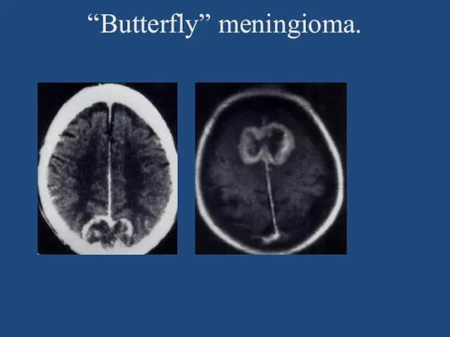“Butterfly” meningioma.