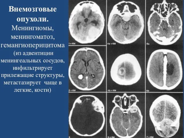 Внемозговые опухоли. Менингиомы, менингоматоз, гемангиоперицитома (из адвентиции менингеальных сосудов, инфильтрирует