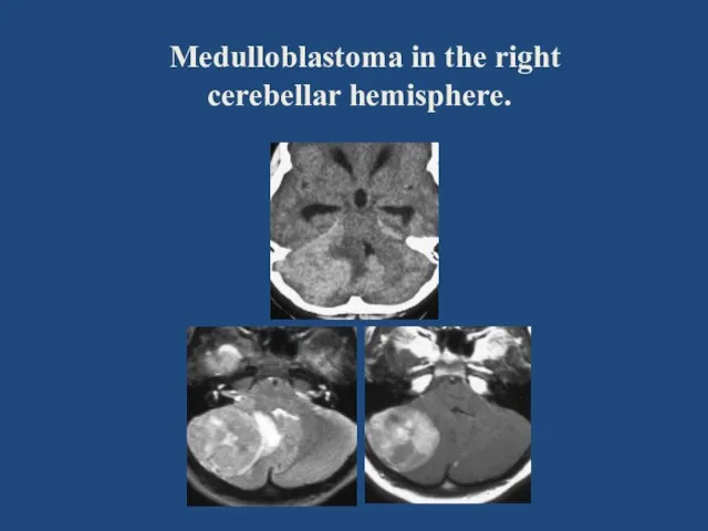 Medulloblastoma in the right cerebellar hemisphere.