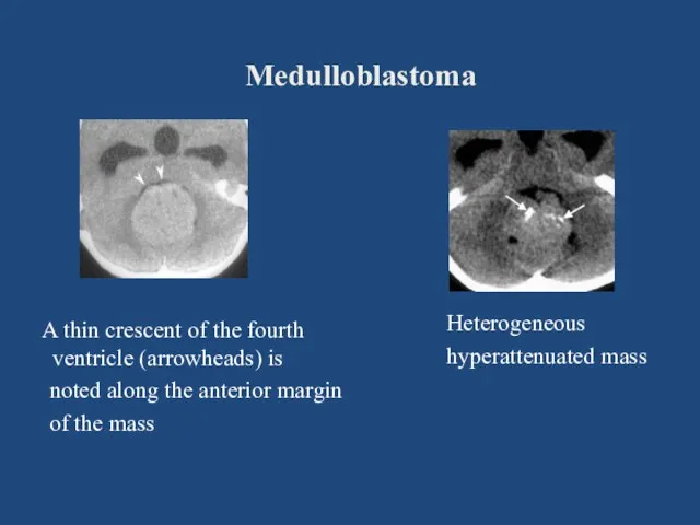 Medulloblastoma Heterogeneous hyperattenuated mass A thin crescent of the fourth