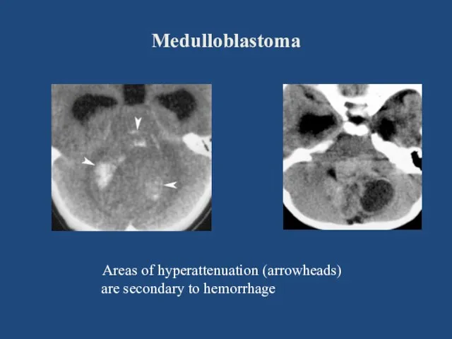 Medulloblastoma Areas of hyperattenuation (arrowheads) are secondary to hemorrhage
