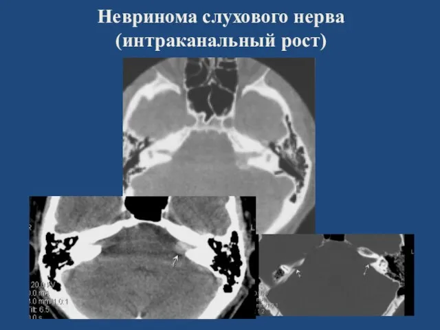 Невринома слухового нерва (интраканальный рост)