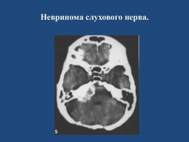 Невринома слухового нерва.