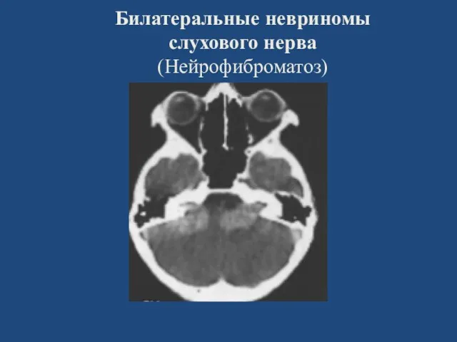 Билатеральные невриномы слухового нерва (Нейрофиброматоз)