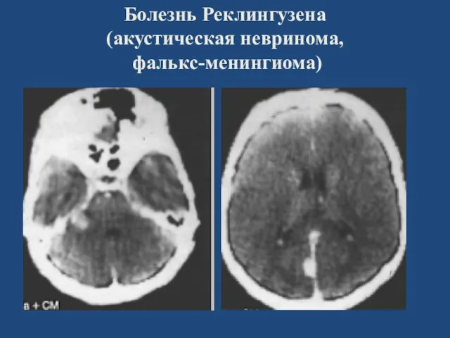 Болезнь Реклингузена (акустическая невринома, фалькс-менингиома)