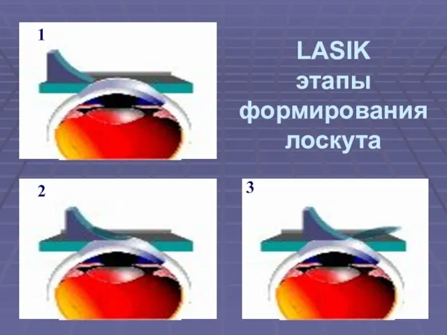 LASIK этапы формирования лоскута 1 2 3
