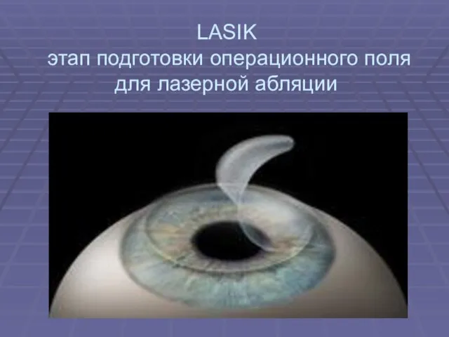LASIK этап подготовки операционного поля для лазерной абляции