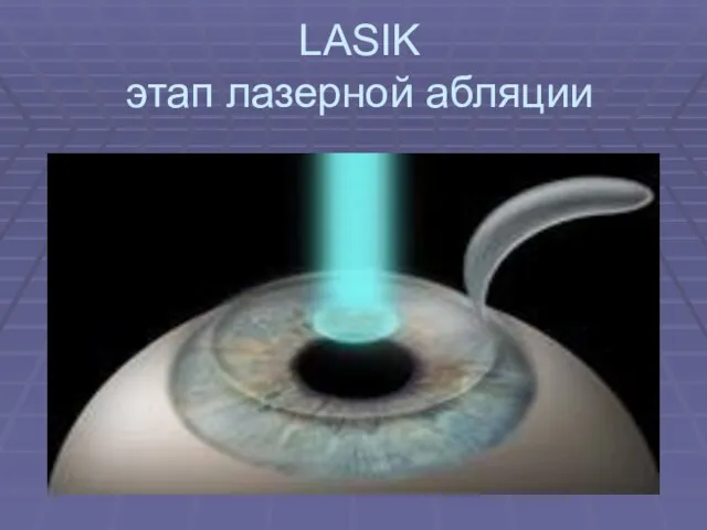 LASIK этап лазерной абляции