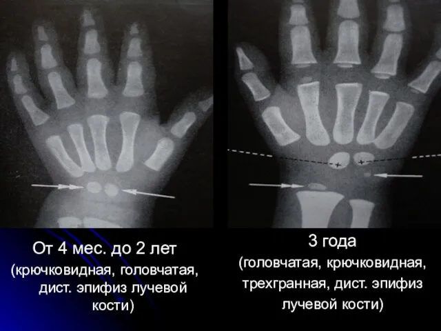 От 4 мес. до 2 лет (крючковидная, головчатая, дист. эпифиз