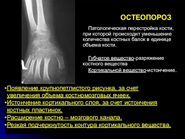 ОСТЕОПОРОЗ Патологическая перестройка кости, при которой происходит уменьшение количества костных