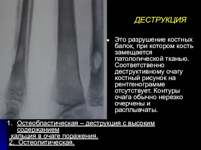 ДЕСТРУКЦИЯ Это разрушение костных балок, при котором кость замещается патологической