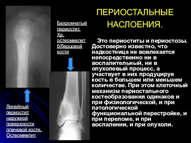 ПЕРИОСТАЛЬНЫЕ НАСЛОЕНИЯ. Это периоститы и периостозы. Достоверно известно, что надкостница