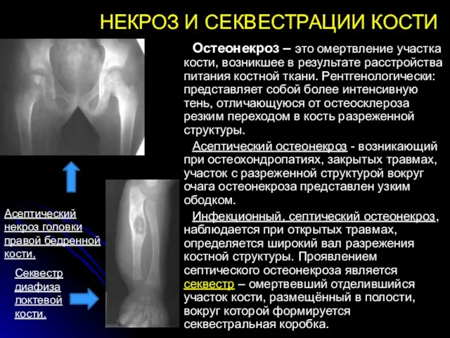 НЕКРОЗ И СЕКВЕСТРАЦИИ КОСТИ Остеонекроз – это омертвление участка кости,