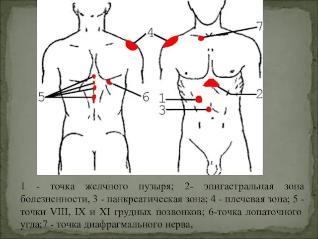 1 - точка желчного пузыря; 2- эпигастральная зона болезненности, 3