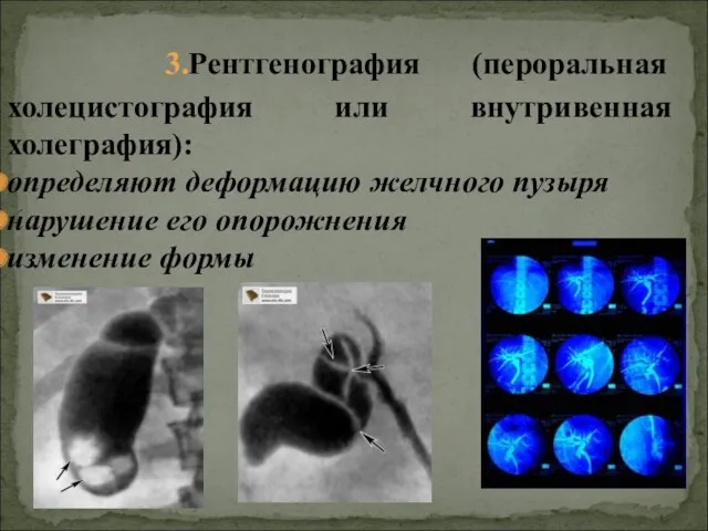 3.Рентгенография (пероральная холецистография или внутривенная холеграфия): определяют деформацию желчного пузыря нарушение его опорожнения изменение формы