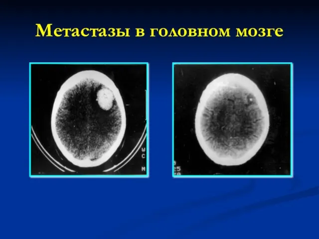 Метастазы в головном мозге
