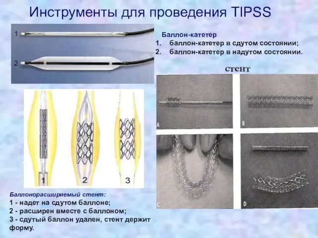 Инструменты для проведения TIPSS Баллон-катетер баллон-катетер в сдутом состоянии; баллон-катетер