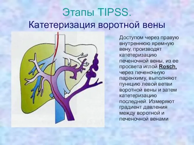 Этапы TIPSS. Катетеризация воротной вены Доступом через правую внутреннюю яремную