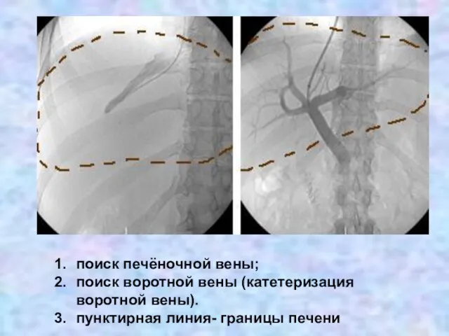 поиск печёночной вены; поиск воротной вены (катетеризация воротной вены). пунктирная линия- границы печени