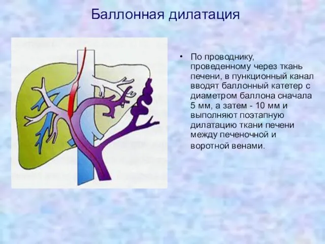 Баллонная дилатация По проводнику, проведенному через ткань печени, в пункционный