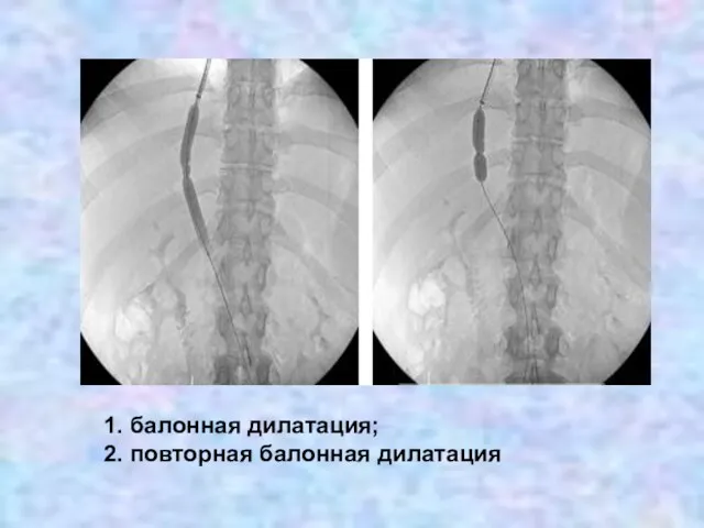 1. балонная дилатация; 2. повторная балонная дилатация