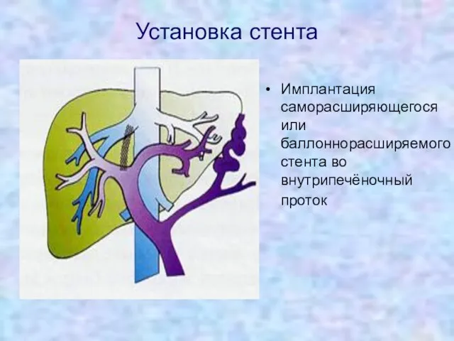 Установка стента Имплантация саморасширяющегося или баллоннорасширяемого стента во внутрипечёночный проток