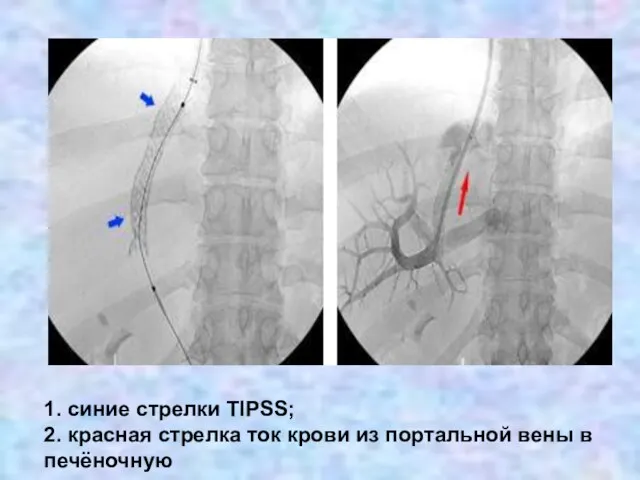 1. синие стрелки TIPSS; 2. красная стрелка ток крови из портальной вены в печёночную