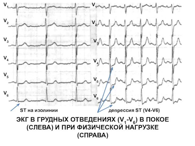 ЭКГ В ГРУДНЫХ ОТВЕДЕНИЯХ (V1-V6) В ПОКОЕ (СЛЕВА) И ПРИ