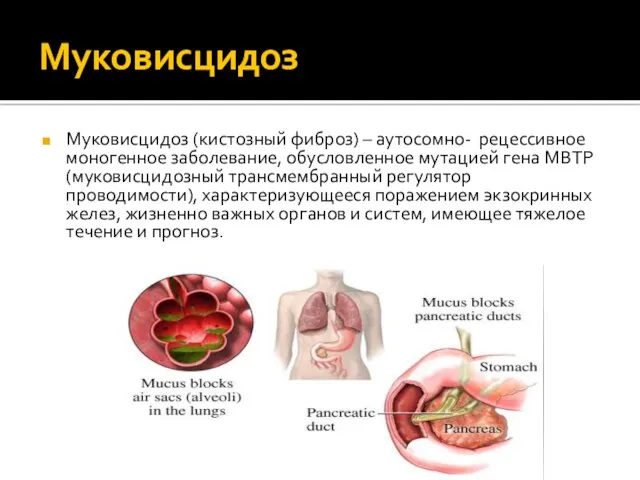 Муковисцидоз (кистозный фиброз) – аутосомно- рецессивное моногенное заболевание, обусловленное мутацией