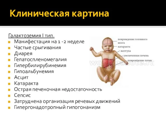 Клиническая картина Галактоземия I тип. Манифестация на 1 -2 неделе