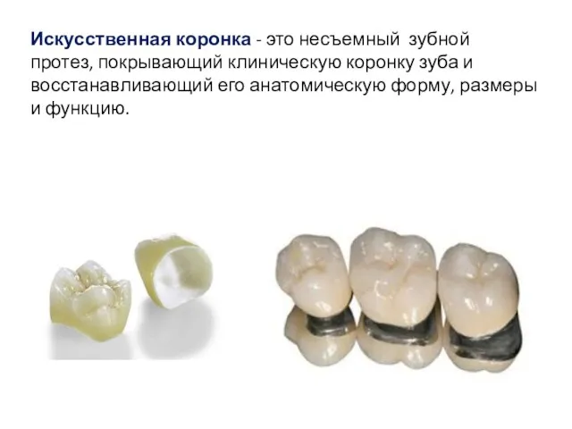 Искусственная коронка - это несъемный зубной протез, покрывающий клиническую коронку зуба и восстанавливающий